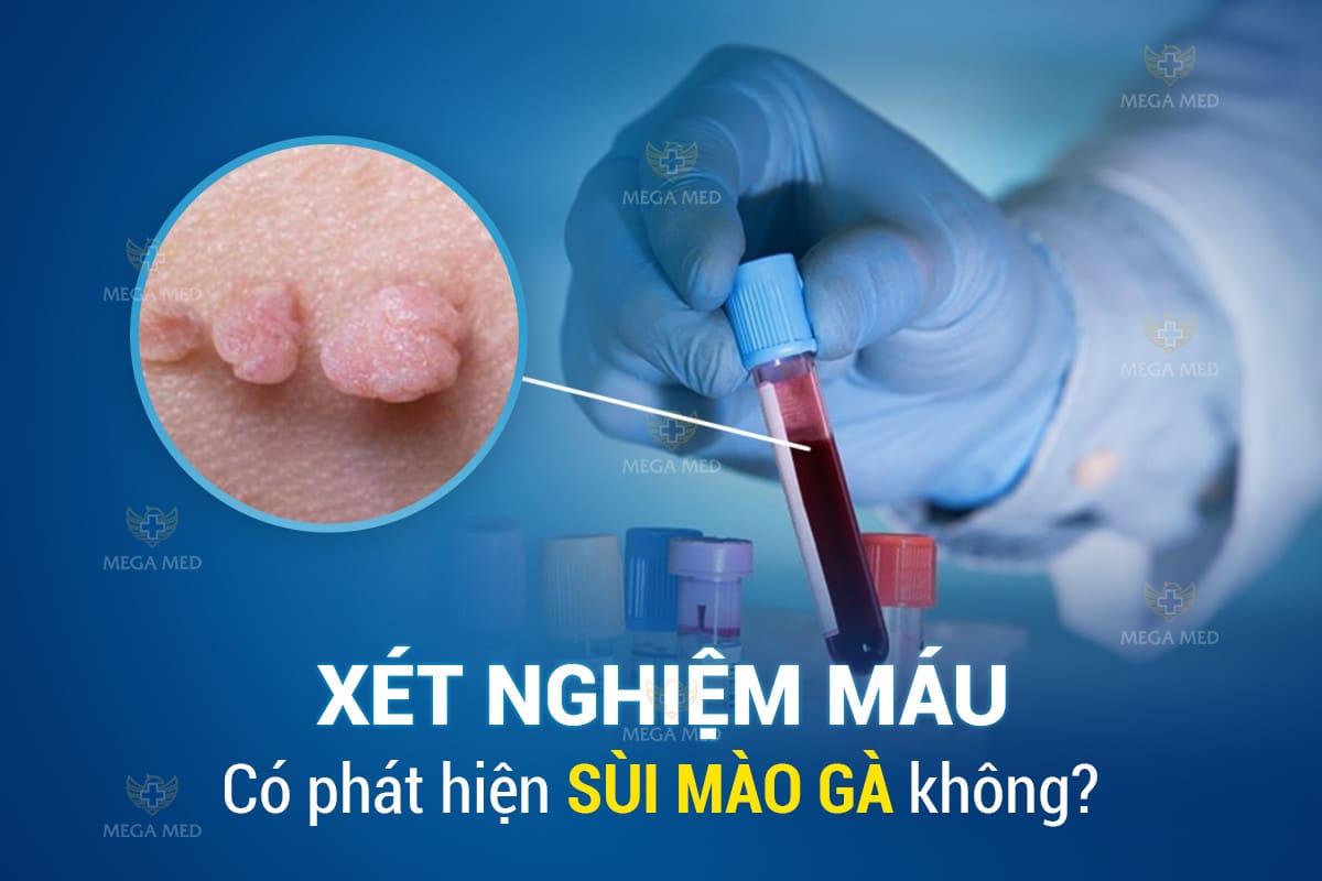 Xét nghiệm máu không phát hiện sùi mào gà